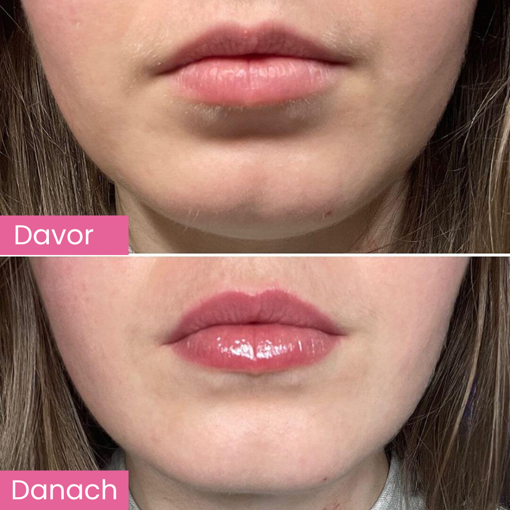 Lip Plumber