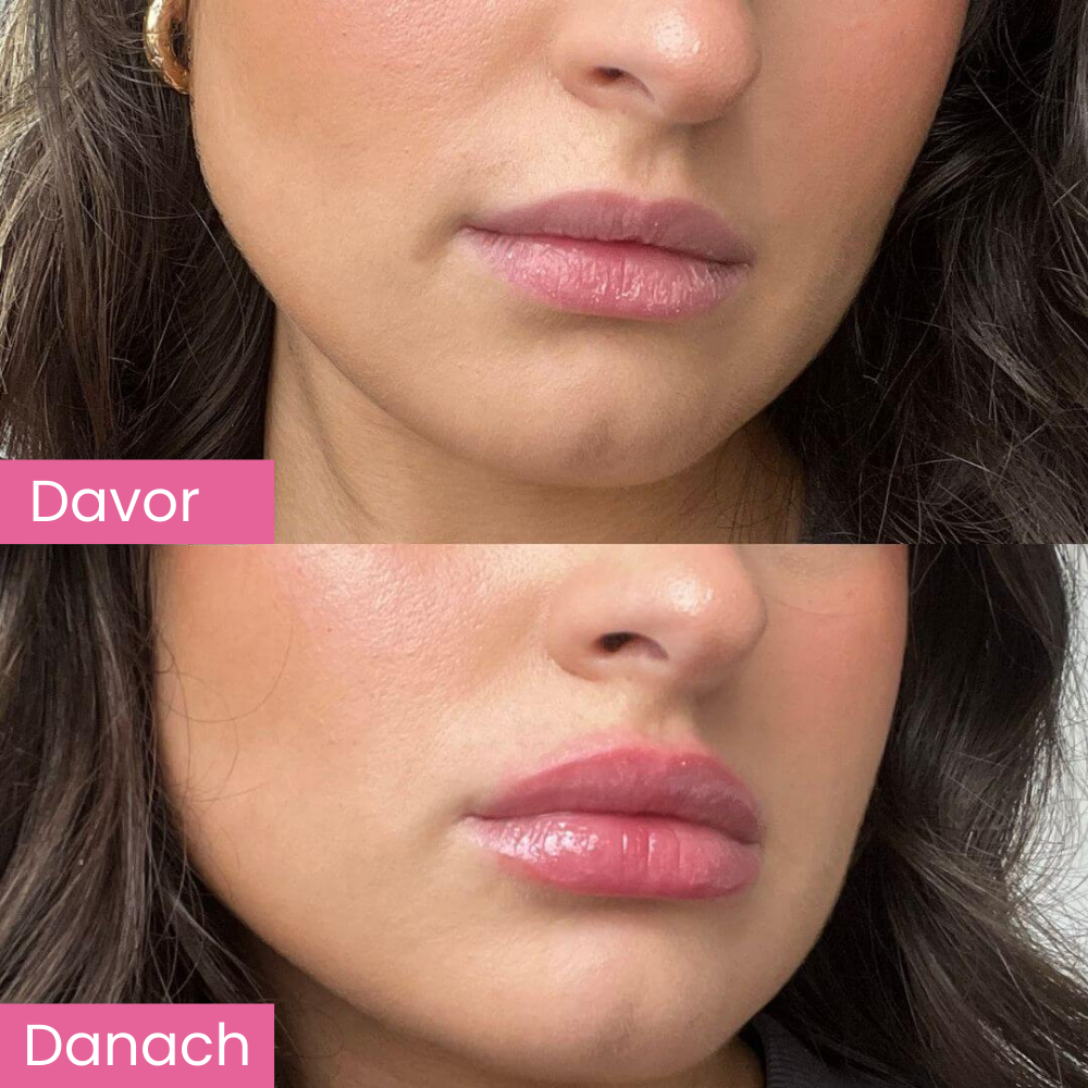 Lip Plumber