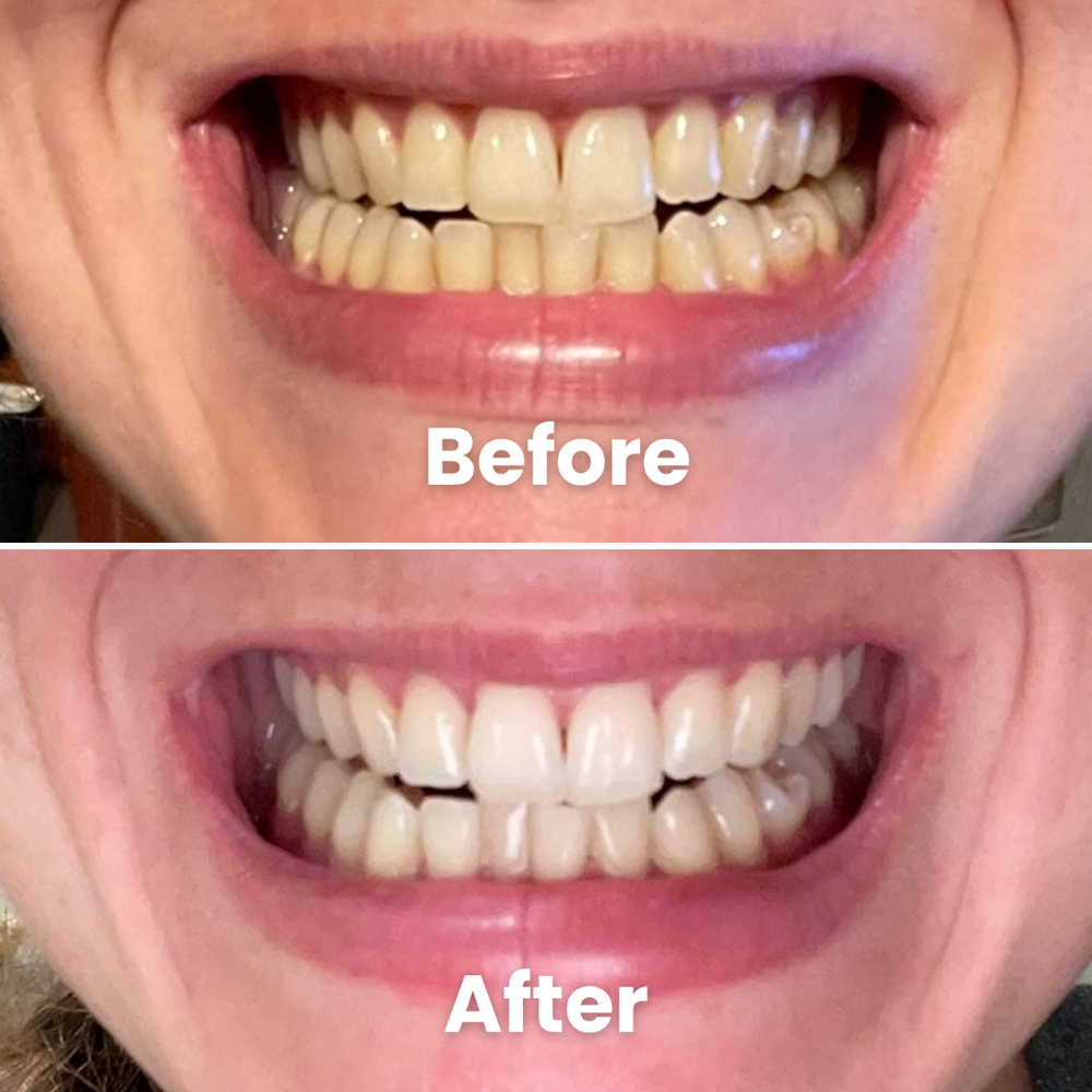 SOVARA Teeth Whitening Powder