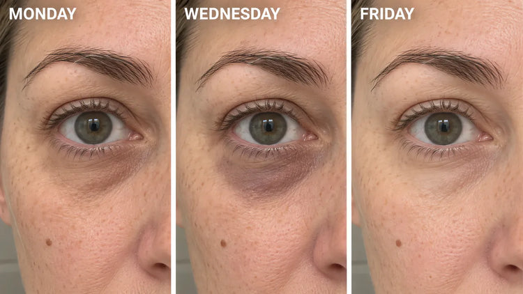 The same woman's eye on Monday, Wednesday and Friday morning before work: the dark circle is there each morning, but darker on some days than others