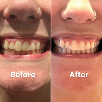 SOVARA Teeth Whitening Powder